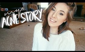 My Acne Story + An Exciting Announcement