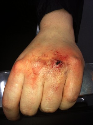 Cut knuckle using wax, wound filler, fake blood and grease paints
