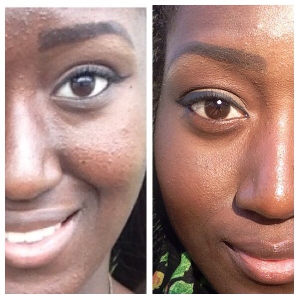 How to get rid of milia? (Baby acne) Beautylish