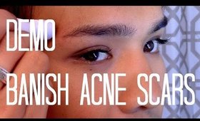 DEMO + REVIEW | BANISH ACNE SCARS