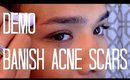 DEMO + REVIEW | BANISH ACNE SCARS