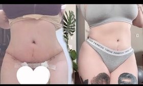 My FULL tummy tuck experience | UPDATE ☆ﾟ.*･