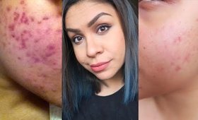 Getting Rid Of My Acne Using Apple Cider Vinegar - Q&A