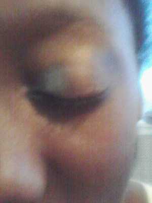 jaylas eye