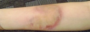 Bruise achieved by alcohol palette. 