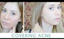 How to Cover Acne Without Looking Cakey