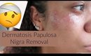 I got my dermatosis papulosa nigra removed