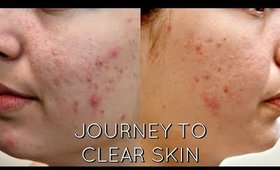 F*CK ACNE!!! - JOURNEY TO CLEAR SKIN