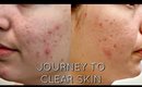 F*CK ACNE!!! - JOURNEY TO CLEAR SKIN