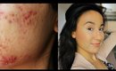 Acne Coverage | 'NO MAKEUP' Makeup Tutorial