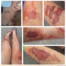 zombie wounds