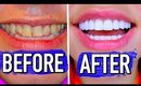 The truth about how I fixed my smile! Veneers Experience
