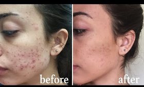 My Acne Story and How I'm Getting Rid of it + GIVEAWAY!
