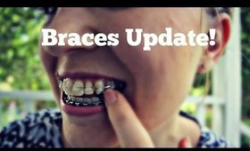 Braces Update!  Plus Instagram Giveaway!