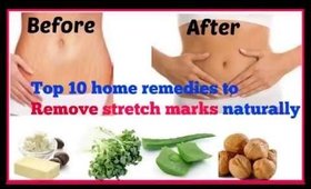 Top 10 home remedies to Remove stretch marks naturally