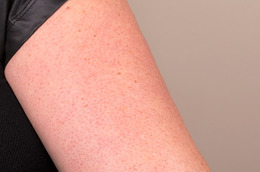 How to Treat Keratosis Pilaris (Those Scaly Red Bumps On Your Upper Arms!)