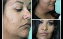 HOW TO COVER CYSTIC ACNE SCARRING  WITHOUT USING FULL COVERAGE MAKEUP