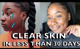 HOW I CLEARED MY SKIN SO FAST! ACNE, PIMPLES AND SCARS!