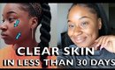 HOW I CLEARED MY SKIN SO FAST! ACNE, PIMPLES AND SCARS!