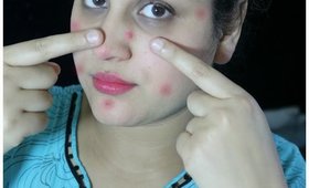How To Get Rid of ACNE- ZITS- PIMPLES Overnight ( FAST results)