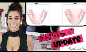 Aligners for Straight Teeth At Home! | Half Way Update | Smile Direct Club