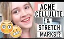 Acne, Cellulite, & Stretch Marks!? | Insecurities 101