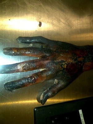 Hand that has been badly burnt in morgue. Nails have been liquidated and clothing material has stuck to them. 