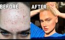 ACNE SKIN CARE ROUTINE/PRODUCTS THAT SAVED MY SKIN! FINALLY.