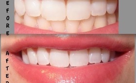 Crest 3D Whitestrips SUCCESS!