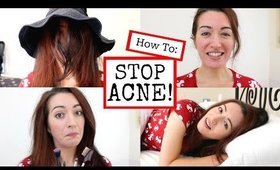 STOP SPOTS NOW! How To Stop Acne The Easy Way!