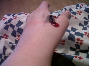 hand wound