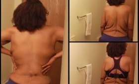 Lower Back Infection After losing 300 Pounds