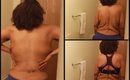 Lower Back Infection After losing 300 Pounds