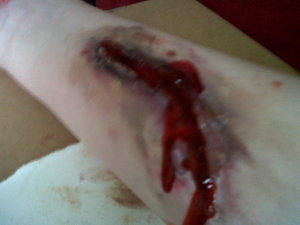 arm wound