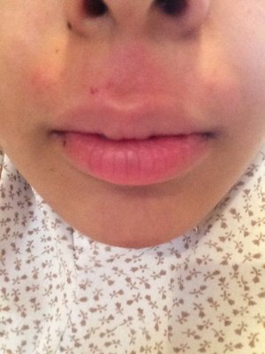 Upper lip wax burn. |