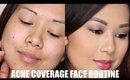 Acne + Dark Spot Coverage Routine | Full Face Concealer + Foundation