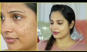 Pimples, Breakout & Acne Free Skin This Summer | ShrutiArjunAnand