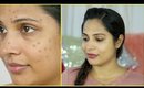 Pimples, Breakout & Acne Free Skin This Summer | ShrutiArjunAnand