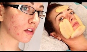 ✔ HOW TO: FADE ACNE SCARS WITH... POTATO?! Natural Mild Scarring Treatment!