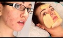 ✔ HOW TO: FADE ACNE SCARS WITH... POTATO?! Natural Mild Scarring Treatment!