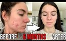 HOW I CLEARED MY SKIN | My Hormonal Acne Journey + Skincare Routine | ALL Natural NO ACCUTANE