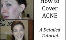 How To Cover Acne - A Detailed Tutorial