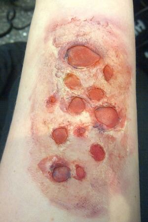 Burnt skin! 