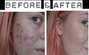 Full Coverage Foundation Routine For Severe Acne/Acne Scars