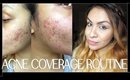 HOW TO COVER ACNE During The Summer - FULL ACNE COVERAGE TUTORIAL | TheRaviOsahn