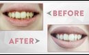 White Teeth in 1 Week! Smile Brilliant Experience + Giveaway!