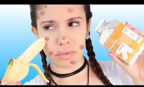 How To Get Rid Of Acne FAST + At Home HACKS!!