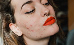 Top 6 Skincare Remedies for Hormonal Acne