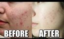 ACNE CHEMICAL PEEL BEFORE AND AFTER, 1 TREATMENT JOURNEY TO CLEAR SKIN