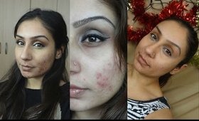 Acne.org does it really work? Is it worth the buy? 4months into using Acne.org results || Raji Osahn